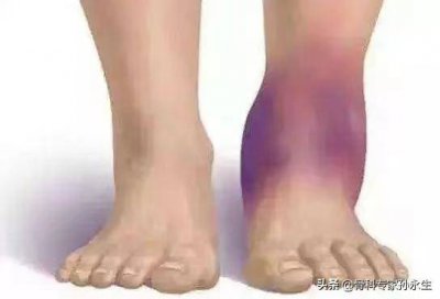 ​脚崴了怎么用红花油 脚崴了擦红花油有用吗