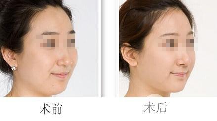 光纤溶脂是什么？哪些人能做？