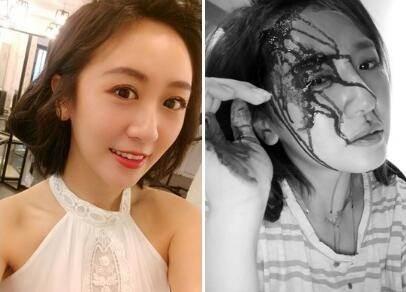 中国台湾艺人蔡允洁睡觉不小心受伤，为何让网友痛骂