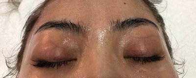 ​鼻子两边老是出油怎么回事