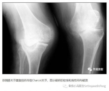 ​「科普」不痛的罕见关节病---夏科氏关节